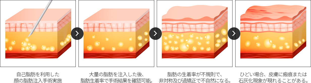 顔の脂肪注入の副作用が起こる過程